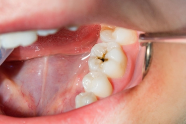 Tooth Cavity Filling in Ganganagar, Cost of Cavity Filling in Meerut, Composite Filling, Treatment for Decayed Tooth, Best dentist for dental cavity treatment, The Dental Doctors, Best Dental Centre in Meerut, Uttar Pradesh